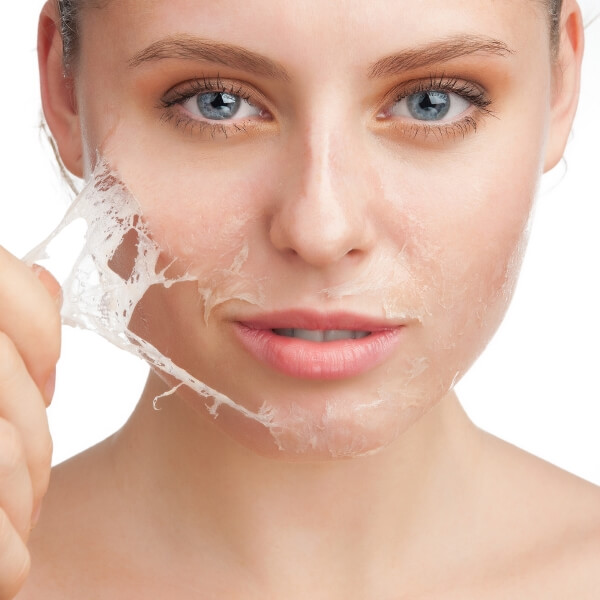 CHEMICAL SKIN PEELING