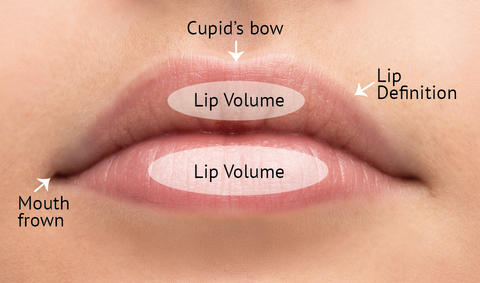 LIP FILLER