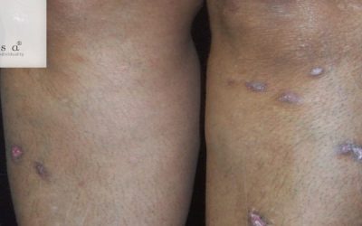 Lichen Planus: Definition, Symptoms, Causes & Treatments