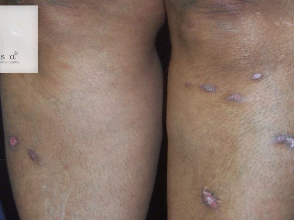 Lichen Planus: Definition, Symptoms, Causes & Treatments